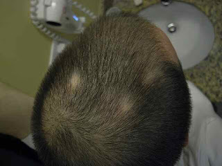 Alopecia areata