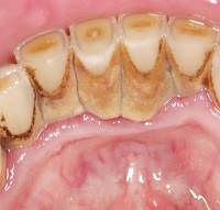 Plaque Dental Problems