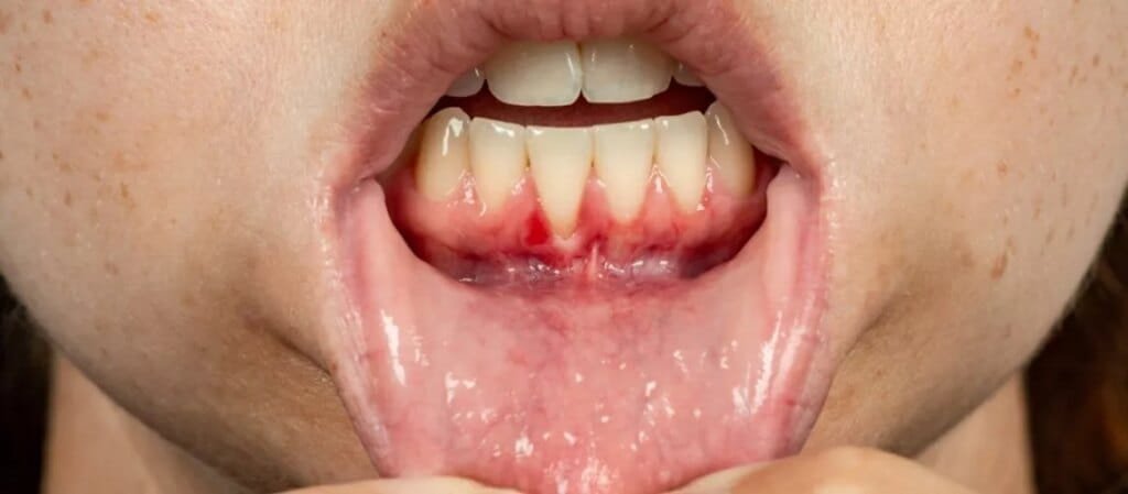 Gum Recession: Causes, Prevention & Treatment And Advice GUM2BRECCESSION