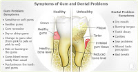 Gingivitis common dental problems