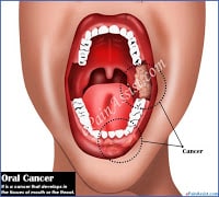 Oral Cancer Common Dental Problems