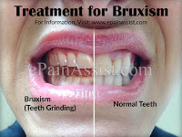 Bruxism