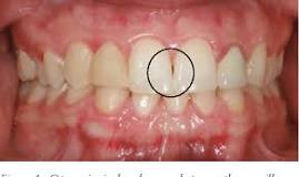 Interdental Papilla The Area Of Your Mouth Most Susceptible To Gingivitis