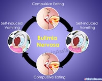 How To Prevent Dental Problems When You Have Bulimia Nervosa