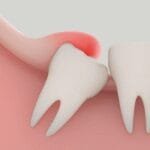 pericoronitis