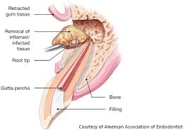 Endodontic Surgery: Root Canal And Apicoectomy Explained