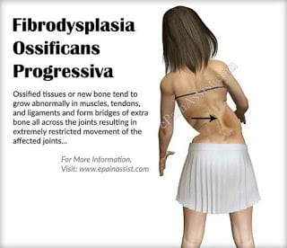 Fibrodysplasia-Ossificans-Progressiva