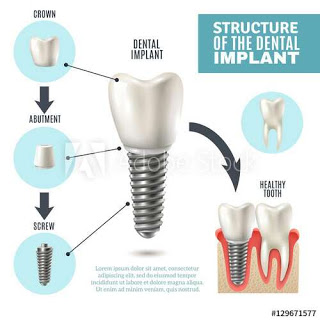 3 Reasons Why You Shouldn't Panic Before and After Implant Surgery
