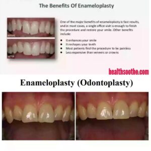 Enameloplasty Tooth Reshaping And Treatment