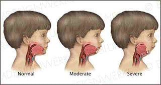 Mandibular-Hypoplasia-Causes-Symptoms-Diagnosis