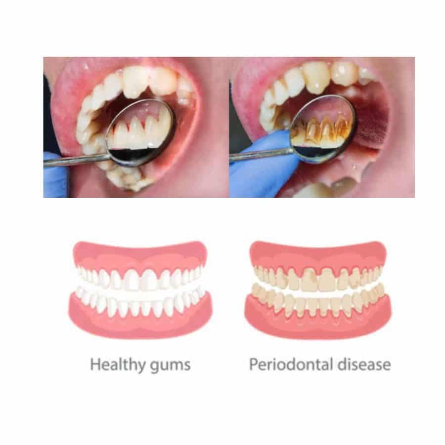Periodontal Disease: Causes, Symptoms, And Treatment
