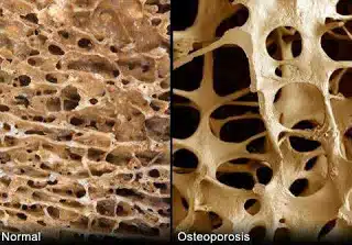 Osteoporosis and dental health