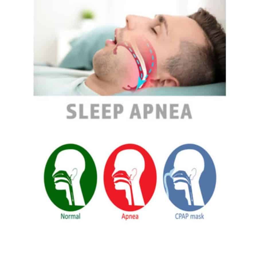 7 Effective Home Remedies For Obstructive Sleep Apnea