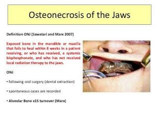 Everything you need to Know About Osteonecrosis of the Jaw