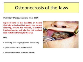 Everything You Need To Know About Osteonecrosis Of The Jaw