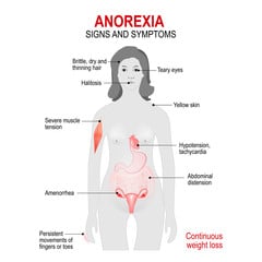 Anorexia Nervosa