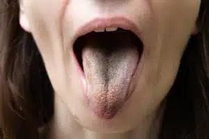 Black tongue and black hairy tongue