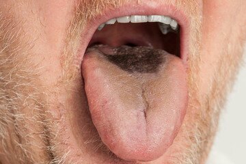 black hairy tongue