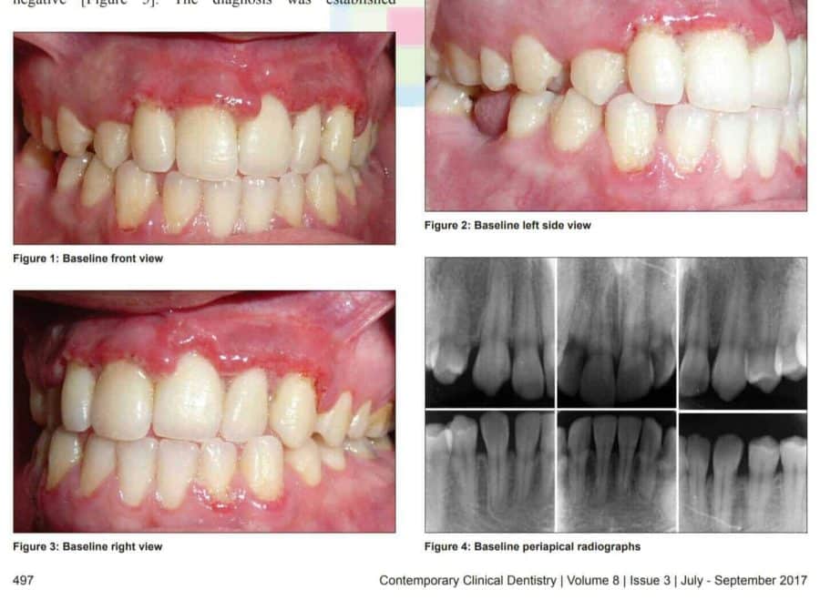 Acute Necrotizing Ulcerative Gingivitis ( ANUG )