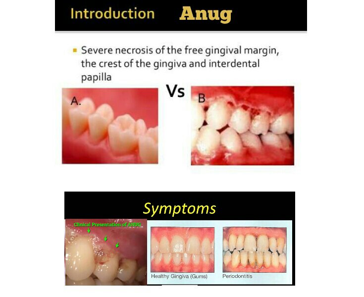 Язвенно некротический гингивит фото