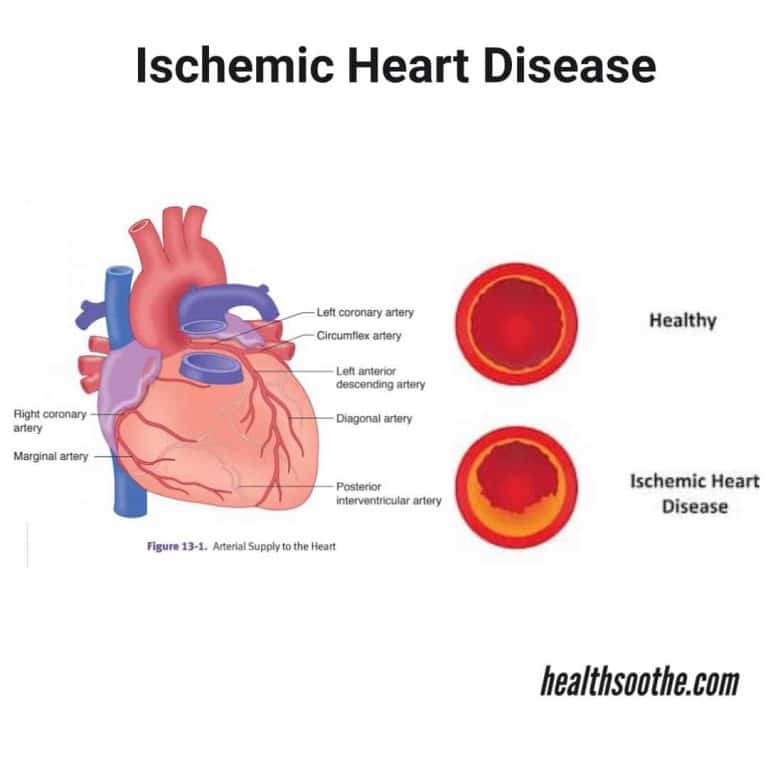 ischemic-heart-disease-symptoms-causes-treatment-and-prevention