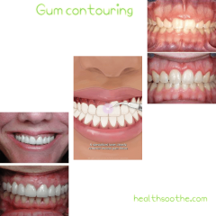 Gum Contouring