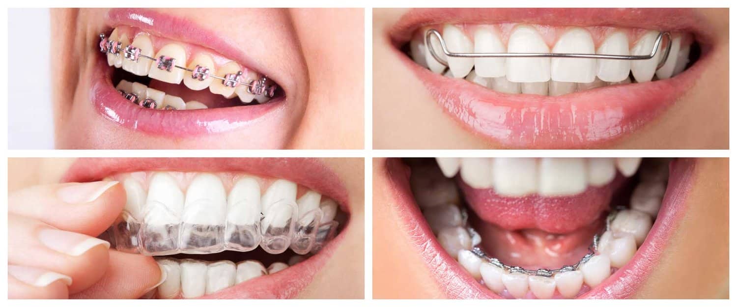 Getting Braces Soon Heres A Guide On Different Kind Of Braces Healthsoothe 