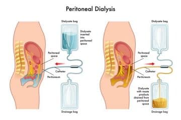 Cost Of Dialysis In Nigeria