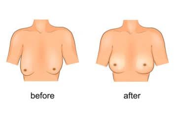 Breast Lift – An Alternative To Breast Implant