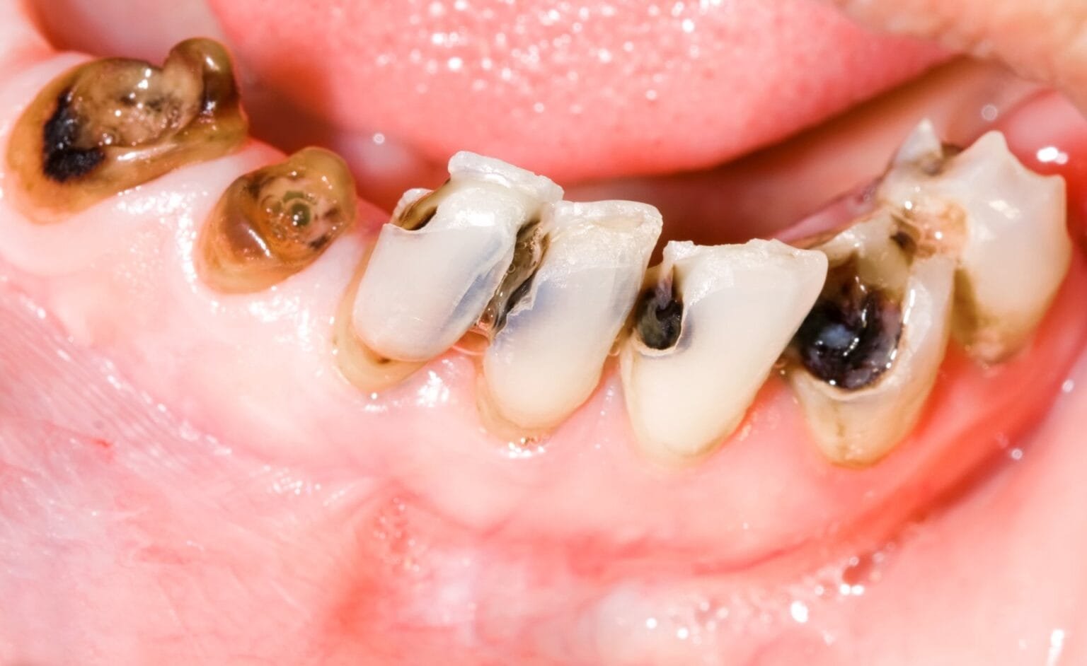 symptomsoftoothdecay