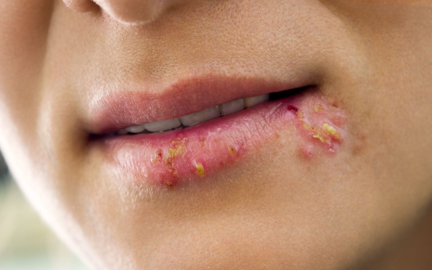 Herpes 101: 6 Things You Need To Know – Healthsoothe: Health And Dental ...