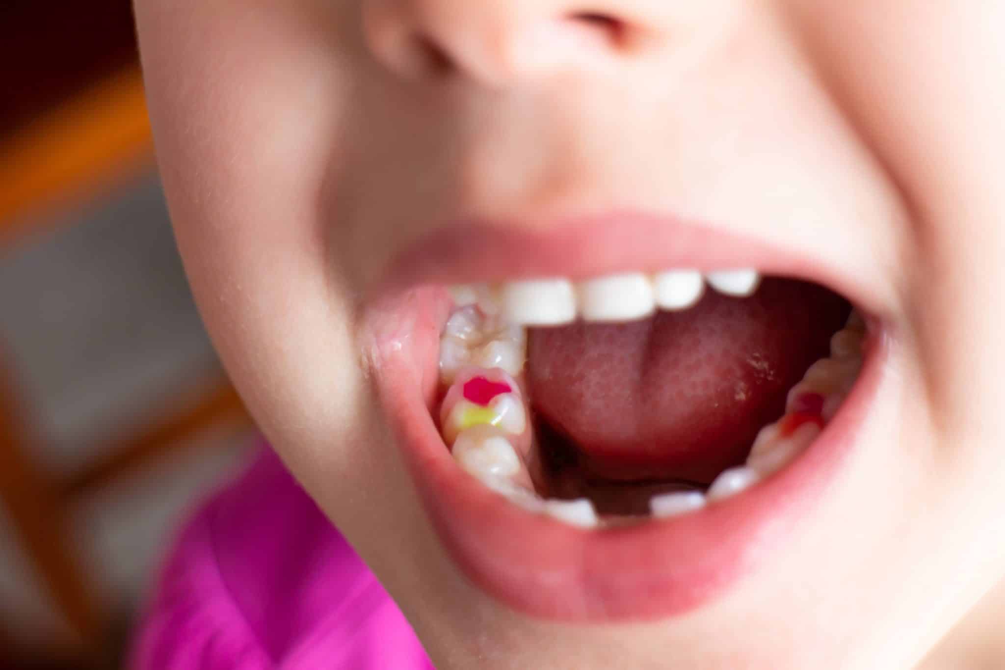 toddler-tooth-decay-5-signs-and-solutions