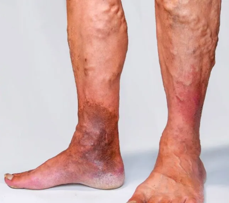 Collapsed Vein | Symptoms, Causes, Treatments, And Prevention