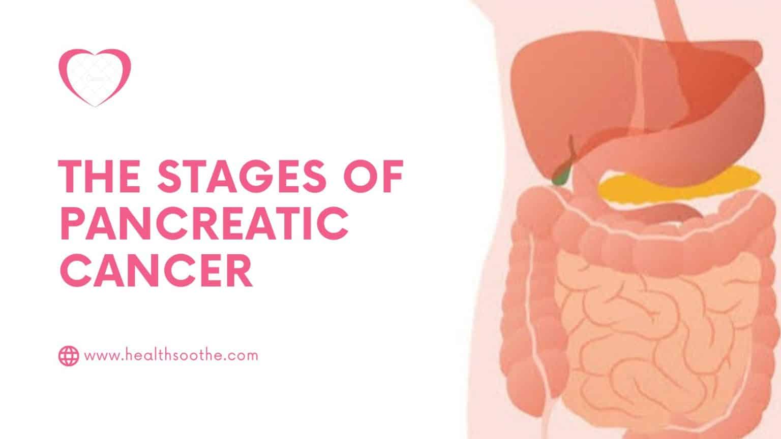 the-stages-of-pancreatic-cancer