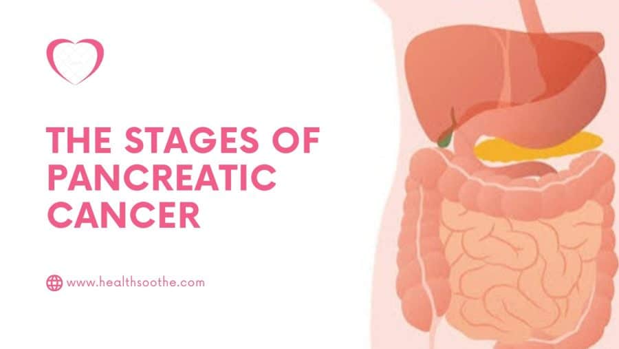 Pancreatic Cancer: Causes, Symptoms, And Susceptibility