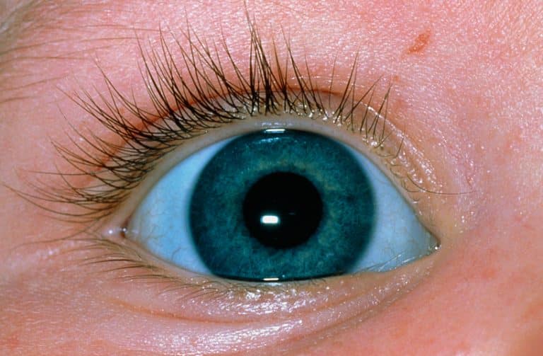 blue-sclera-symptoms-causes-prevention-and-treatment-healthsoothe