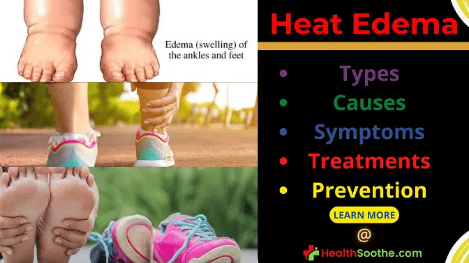 Heat Edema | Types, Causes, Symptoms, Treatments & Prevention