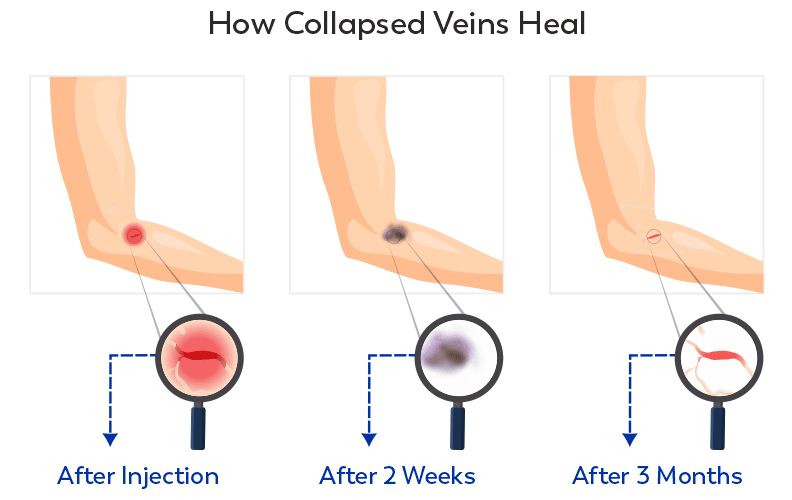Collapsed Vein Symptoms, Causes, Treatments, And Prevention