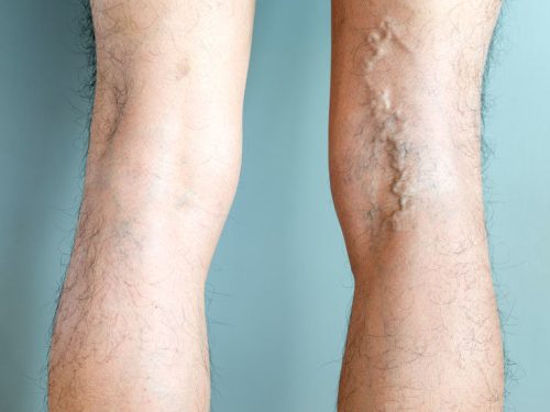 collapsed-vein-symptoms-causes-treatments-and-prevention