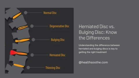 Herniated Disc Vs. Bulging Disc: Know The Differences