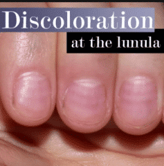 Lunula Discoloration - Healthsoothe