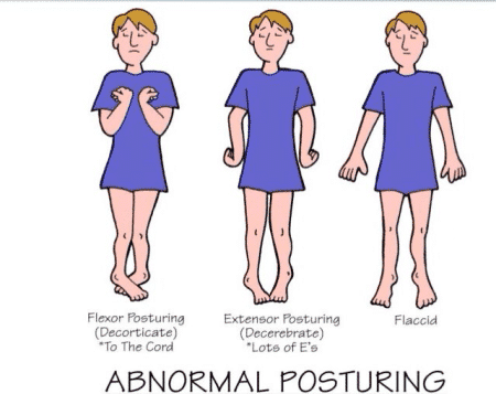 Posture Comparison: Decorticate Vs. Decerebrate