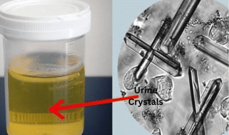 Crystals in Urine | Find out What Causes This, The Symptoms, Treatments ...