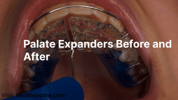 Palate Expanders Before And After