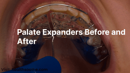 Palate Expanders Before And After