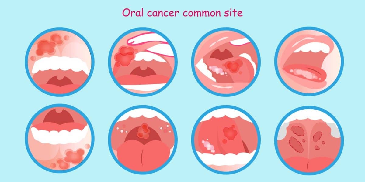 Benefits Of Oral Cancer Screening Everything You Should Know