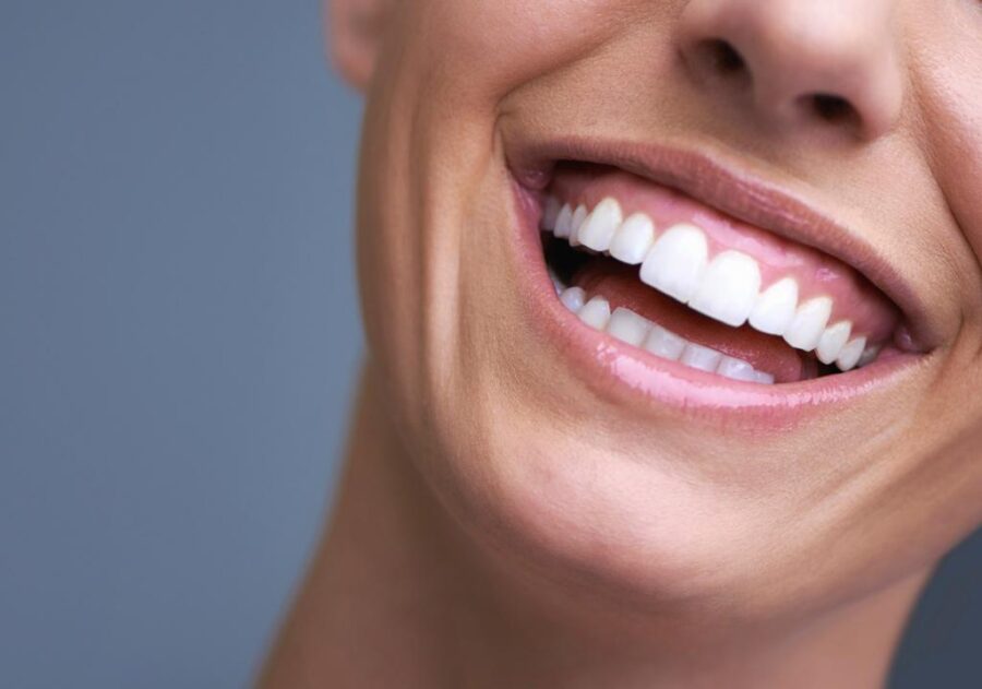 Smile Makeover – Premium Dental Center