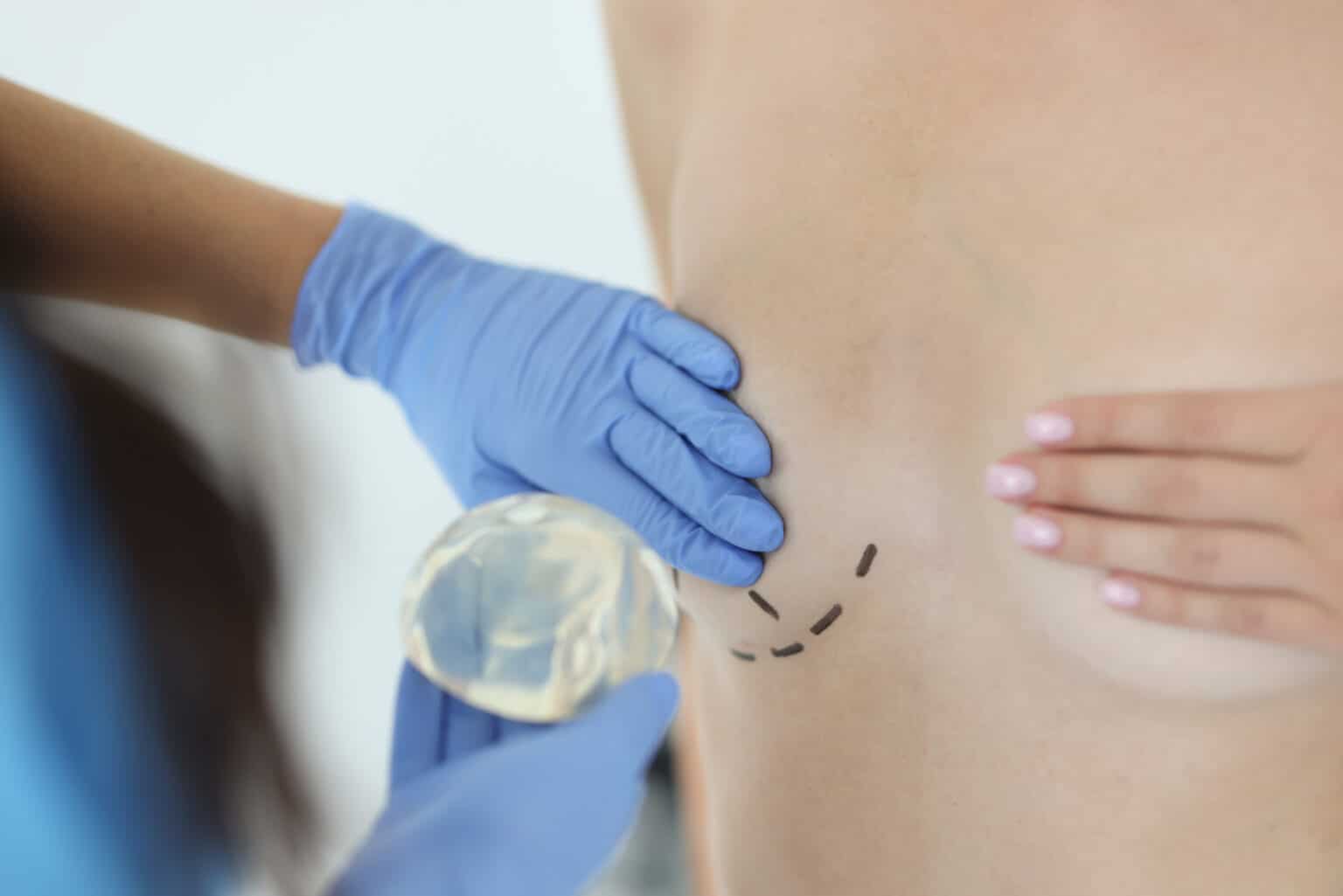Life After Breast Implant Removal: 6 Things To Expect