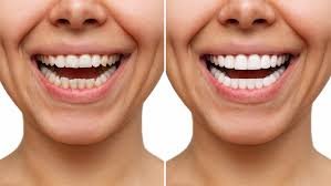 Hollywood Smile in Turkey: Affordable Dental Veneers for American Patients — Cost, Packages & Booking Guide Turkey