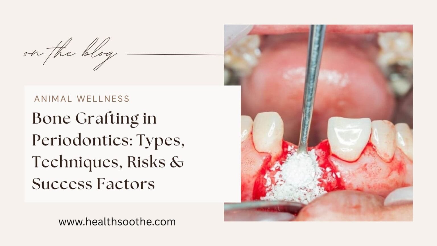 Bone Graft